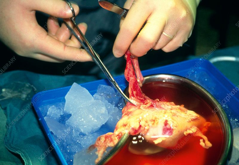 Kidney Transplant