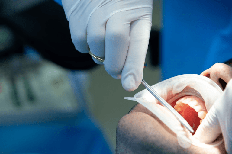 Dental Crowns Treatment