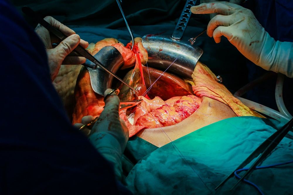 Liver Transplant